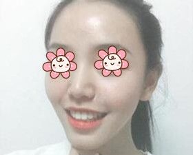 把我在湘潭雅美做自体脂肪丰额头太阳穴术后45天恢复效果图跟大家分享一下！ 案例图2