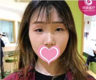 上海割双眼皮那家好?我在上海华美找侣同帅做芭比眼综合宛如天生