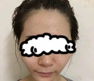我都没敢相信赣州叶子医疗美容钟林辉给我做完自体脂肪填充全脸后变成了旺夫脸