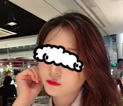 我都没敢相信赣州叶子医疗美容钟林辉给我做完自体脂肪填充全脸后变成了旺夫脸 案例图2