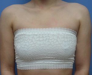 我找宁波美莱喻正虹做傲若拉假体隆胸275cc三个月恢复效果图