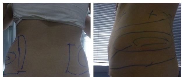腰腹吸脂多久消肿见到效果?到连云港华美体验过的小仙女说术后一周就要换小码塑身衣了