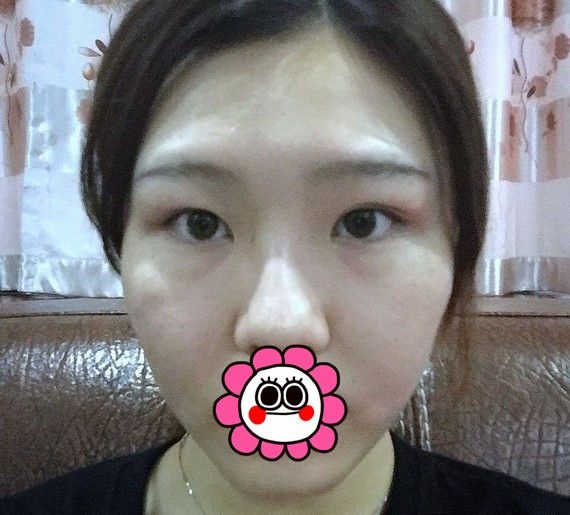 感谢妈妈帮我找温州艺星眼整形医做了双眼皮修复后变的更美了