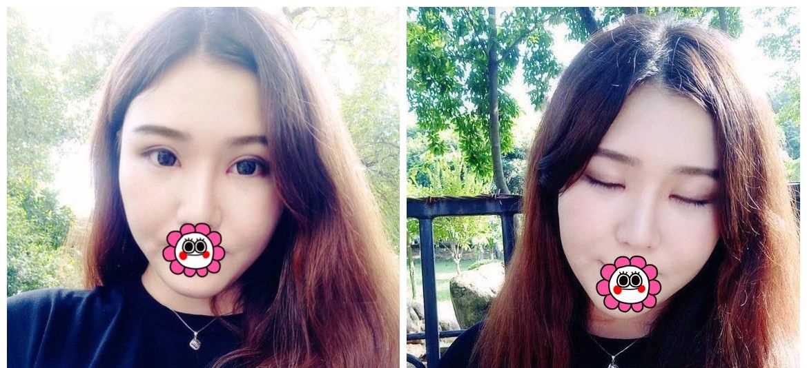 感谢妈妈帮我找温州艺星眼整形医做了双眼皮修复后变的更美了 图2