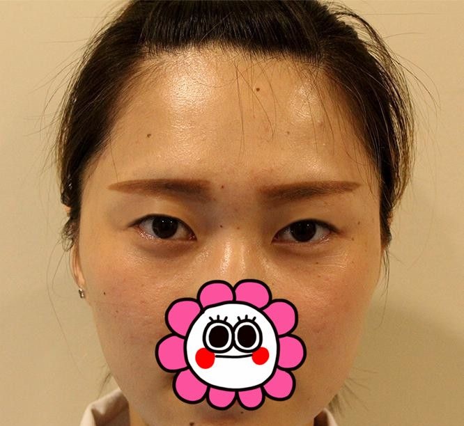 都说宁波雅韩龚涛做鼻子效果好,我觉着他给我做的双眼皮效果也挺满意的