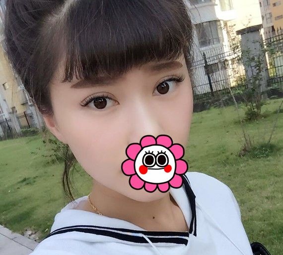 都说宁波雅韩龚涛做鼻子效果好,我觉着他给我做的双眼皮效果也挺满意的 图2