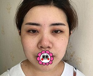 咨询和对比了多家医院后选择靠谱的宁波童颜依美做了耳软骨隆鼻
