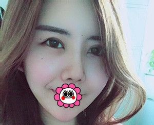 咨询和对比了多家医院后选择靠谱的宁波童颜依美做了耳软骨隆鼻 图2