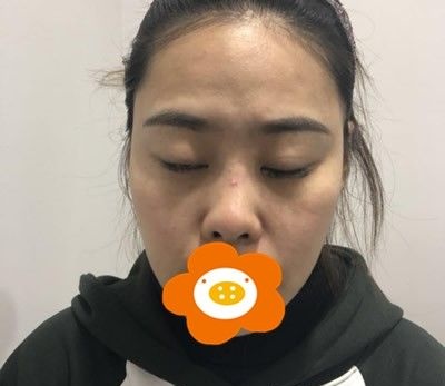 将我在厦门薇格整形找高勇医生做肋软骨综合隆鼻案例对比图分享出来