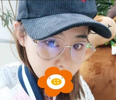 将我在厦门薇格整形找高勇医生做肋软骨综合隆鼻案例对比图分享出来 案例图2