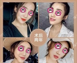 看两年前在沈阳百嘉丽做超体+自体软骨隆鼻的小姐姐现在竟然变成这样了! 图2