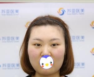 靠偏方消除天生肿泡眼是不可能了 幸好我早早来唐山苏亚美联臣做全切双眼皮+开眼角才拥有现在的灵动大眼