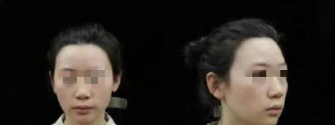 我也是做了自体耳软骨+假体隆鼻后才知道济南艺星整形医院口碑好不是虚的