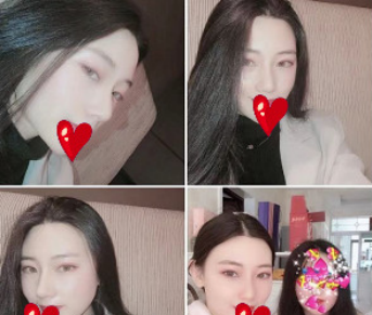我也是做了自体耳软骨+假体隆鼻后才知道济南艺星整形医院口碑好不是虚的 案例图2