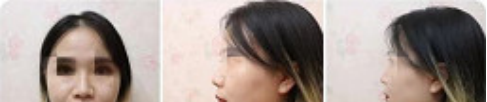 济南美莲真的是一家正规的医院,看我在美莲做的玻尿酸填充下巴手术就知道了