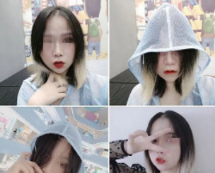 济南美莲真的是一家正规的医院,看我在美莲做的玻尿酸填充下巴手术就知道了 图2