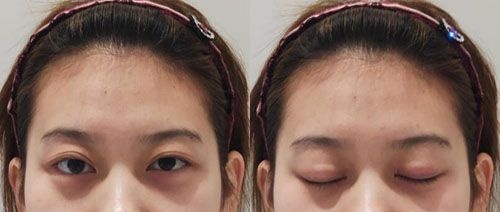 想了解荆州华美双眼皮修复技术怎么样的来看李军眼部疤痕增生出疙瘩修复案例图