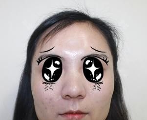 纠结鼻翼缩小术后越变越大,不如看我在太原这家医院术后68天的真实情况再考虑要不要手术