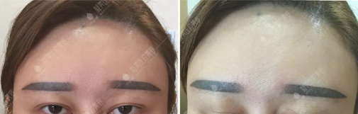 睁眼无力、闭眼疤痕明显,攀枝花凝美曹阳院长的双眼皮修复手术帮我找回美丽!