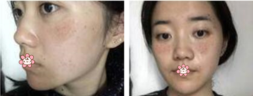 重庆美莱张东梅三万多给我做的这激光祛斑效果我觉得不但不亏还很值!