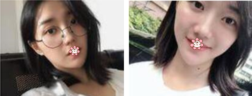 重庆美莱张东梅三万多给我做的这激光祛斑效果我觉得不但不亏还很值! 图2