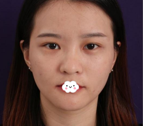​找东莞美立方做眼睛很好的张克医生做完双眼皮修复后拿到一份割双眼皮价格表