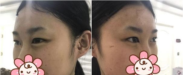 5张割双眼皮恢复日记图揭晓连云港榜上有名的眼部整形医师孙振东到底技术怎样