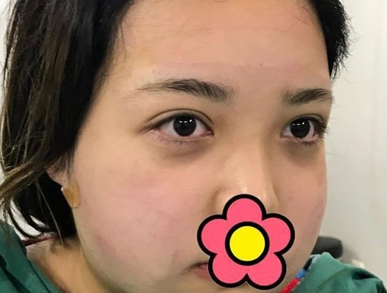不磨骨如何改脸型?兰州时光逯岩院长给我做完面部吸脂10天图片和案例告诉你答案!