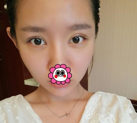 找网红人气医院宁波童颜依美花了不到万元做的双眼皮恢复效果 图2