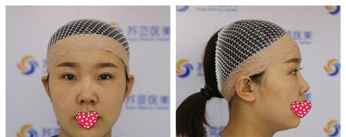 对自己的大鼻头不满已久 今天终于找李春雷医生做肋软骨鼻综合术圆了我的翘鼻梦
