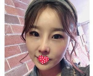 对自己的大鼻头不满已久 今天终于找李春雷医生做肋软骨鼻综合术圆了我的翘鼻梦 图2