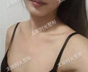 术前空杯绝望,术后望杯兴叹,两者的差距只是因为在太原时光植入了300cc假体隆胸
