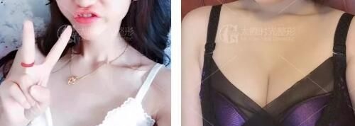 术前空杯绝望,术后望杯兴叹,两者的差距只是因为在太原时光植入了300cc假体隆胸 图2