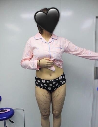 查询荆州华美是可以做吸脂手术医院就找宋占春院长做了大腿抽脂手术
