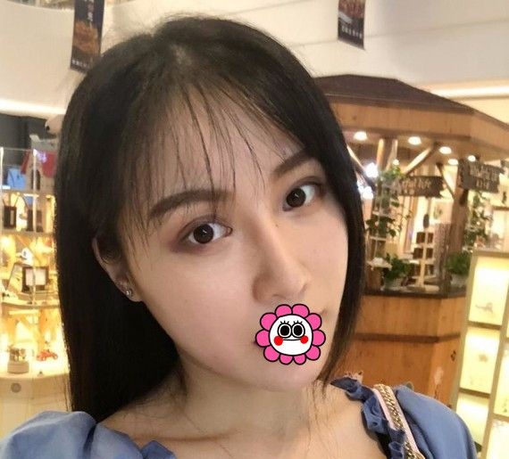 在宁波艺星找肖庆华做肋软骨综合隆鼻恢复两个月后面部更加协调了 图2