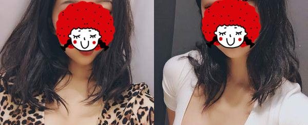 对比过250和275假体大小后，我在南京美贝尔医生建议下做了美国进口曼托毛面假体降低包膜挛缩概率 案例图2