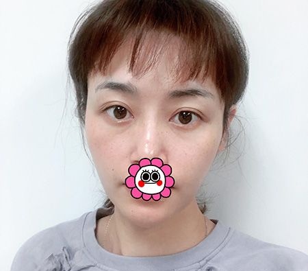 面部凹陷显老气找张广巍医生做全脸脂肪填充后脸部饱满有型还更减龄