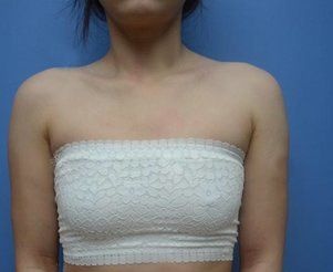 不知道隆胸300cc假体有多大参考我在宁波美莱找姚远医生做的假体隆胸效果