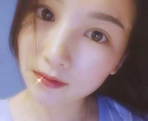 晒一下我在宁波壹加壹找林勇做的全切双眼皮一个月恢复过程图 图2