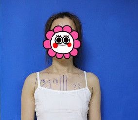 找宁波壹加壹郭光烨做了假体隆胸后感觉技术不错推荐给大家