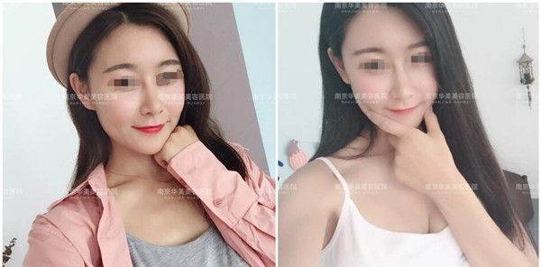 高颧骨的她面诊南京华美做自体脂肪填充全面部改善凹陷太阳穴+额面部后不用磨骨了 图2