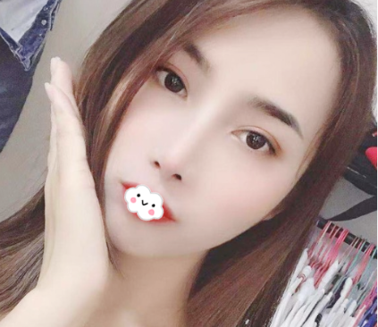 我看深圳阳光整形医院口碑评价好收费也不高就找陈星光做了双眼皮找罗志敏做了鼻子 图2