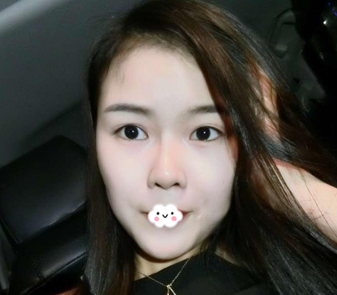 广州紫馨整形医院除了曹仁昌之外,谷琪医生的双眼皮修复案例和技术也很靠谱哦