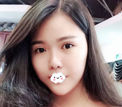 广州紫馨整形医院除了曹仁昌之外,谷琪医生的双眼皮修复案例和技术也很靠谱哦 图2