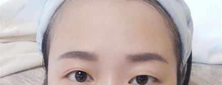 成都友谊医院贾敏纳米无痕定点双眼皮术后效果图:做了手术我就变成甜姐儿了