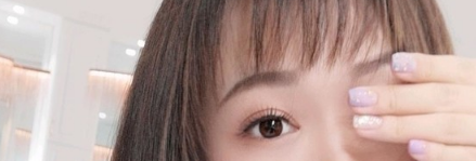 成都友谊医院贾敏纳米无痕定点双眼皮术后效果图:做了手术我就变成甜姐儿了 图2