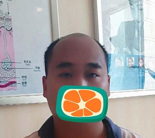 在成都碧莲盛用SHT无痕种植技术植发际线加头顶加密2500单位后改善了我的地中海发型