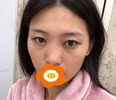 一篇在泉州欧菲做肋软骨综合隆鼻术后心得分享,个人感觉挺适合自己的脸型