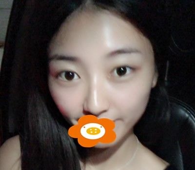 一篇在泉州欧菲做肋软骨综合隆鼻术后心得分享,个人感觉挺适合自己的脸型 图2