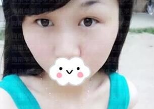 看了我找海南华美赵晓兰做的眼综合45天恢复效果后堂姐说准备也去做一个！